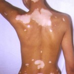 A woman with vitiligo. Photo from Bybyedoctor.